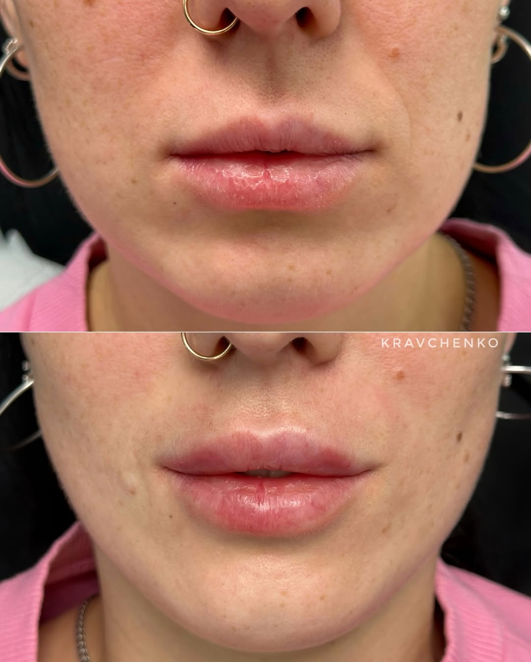 Збільшення губ гіалуроновою кислотою, фото - Врач-косметолог Филипп Кравченко