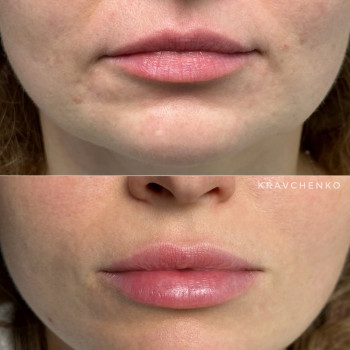 Збільшення губ гіалуроновою кислотою