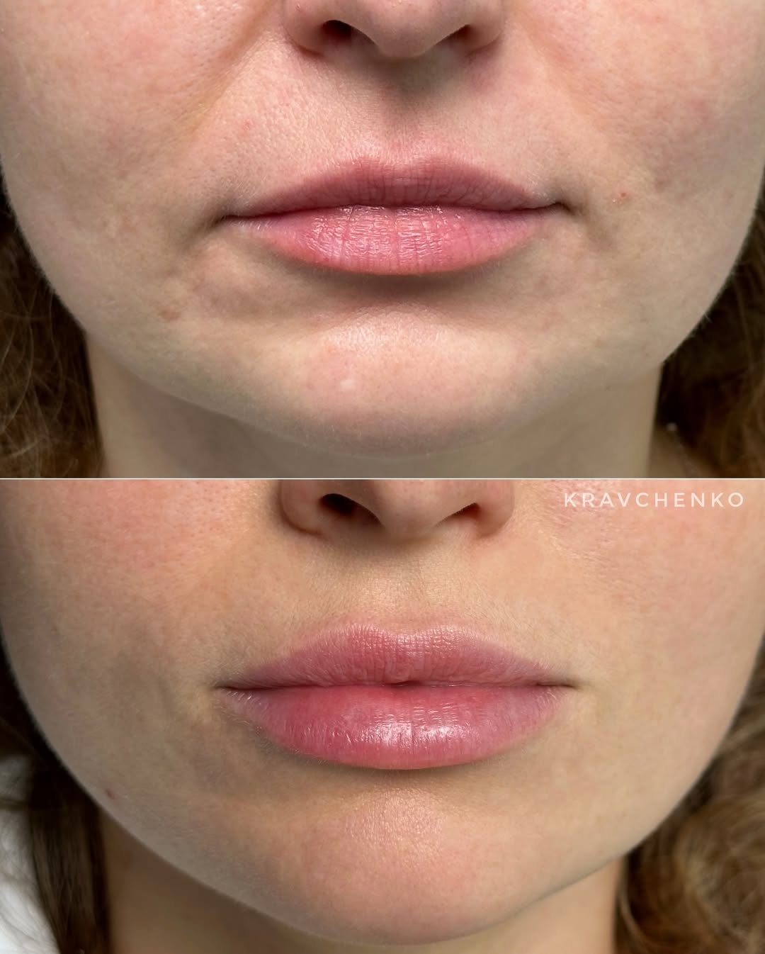 Збільшення губ гіалуроновою кислотою, фото - Врач-косметолог Филипп Кравченко