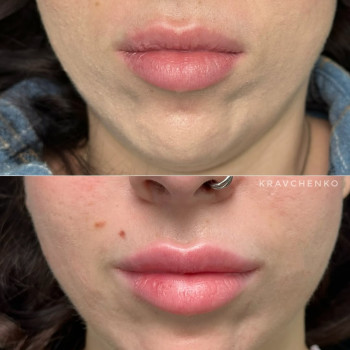 Збільшення губ гіалуроновою кислотою