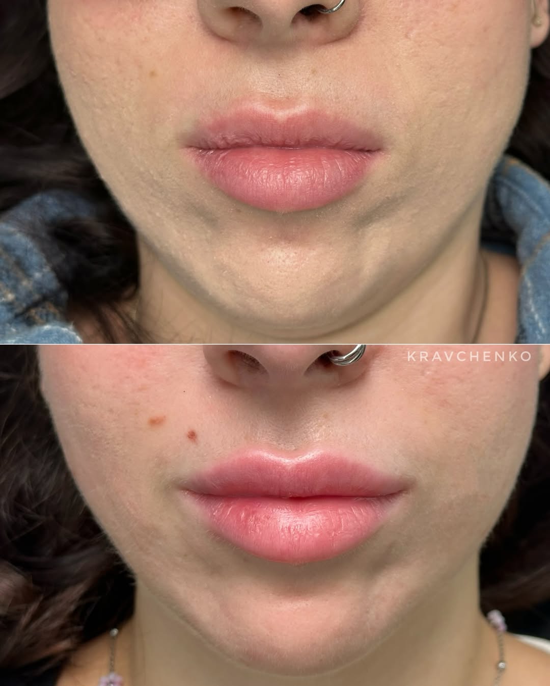 Збільшення губ гіалуроновою кислотою, фото - Врач-косметолог Филипп Кравченко
