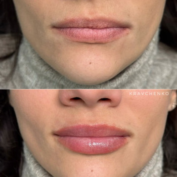 Збільшення губ гіалуроновою кислотою