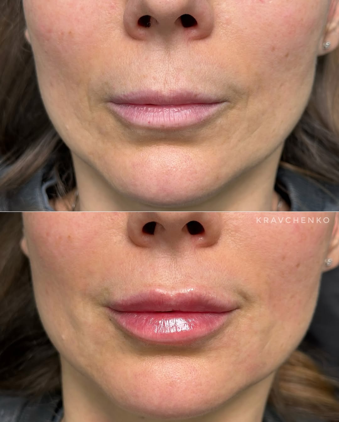 Збільшення губ гіалуроновою кислотою, фото - Врач-косметолог Филипп Кравченко