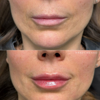 Збільшення губ гіалуроновою кислотою
