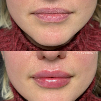 Збільшення губ гіалуроновою кислотою