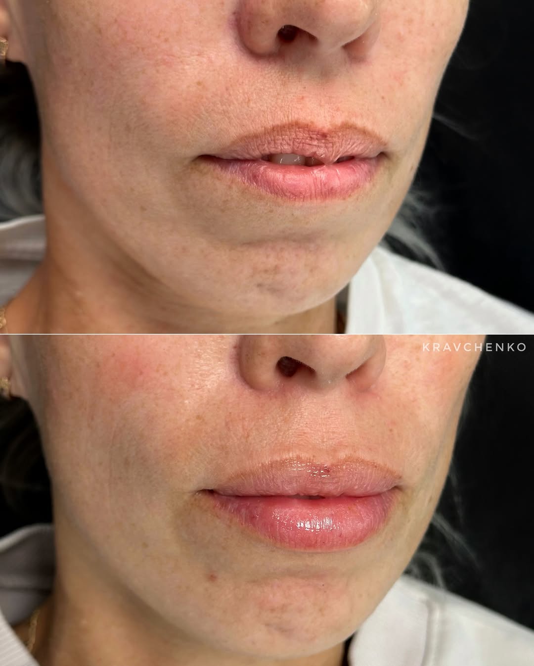 Збільшення губ гіалуроновою кислотою, фото - Врач-косметолог Филипп Кравченко