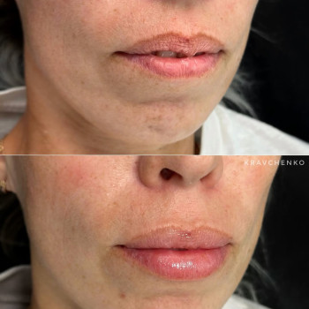 Збільшення губ гіалуроновою кислотою
