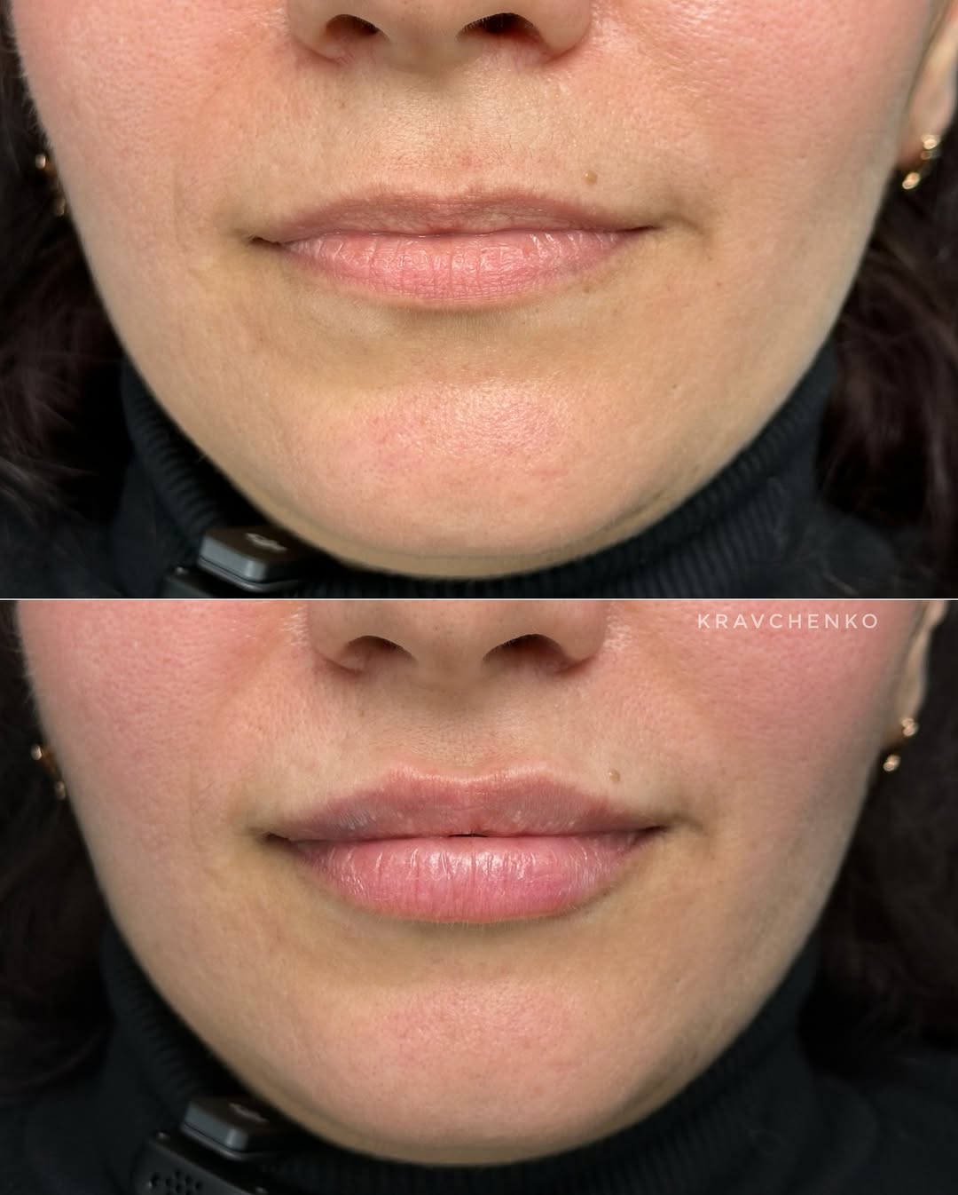 Збільшення губ гіалуроновою кислотою, фото - Врач-косметолог Филипп Кравченко