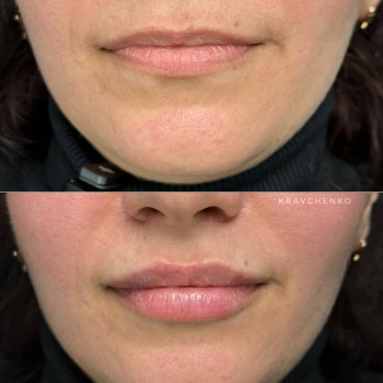 Збільшення губ гіалуроновою кислотою