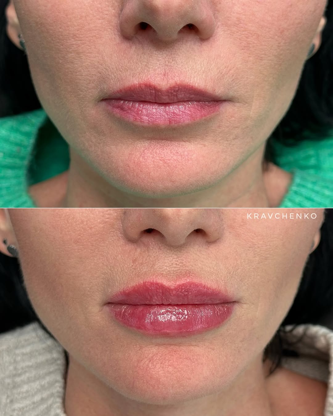 Збільшення губ гіалуроновою кислотою, фото - Врач-косметолог Филипп Кравченко