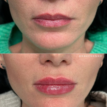 Збільшення губ гіалуроновою кислотою