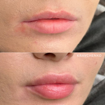 Збільшення губ гіалуроновою кислотою