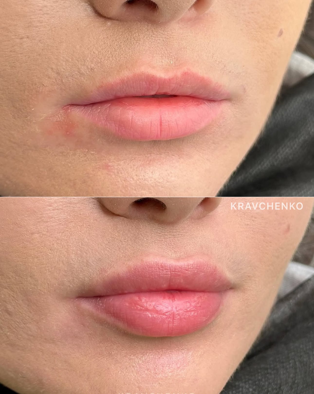 Збільшення губ гіалуроновою кислотою, фото - Врач-косметолог Филипп Кравченко