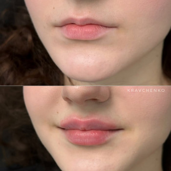 Збільшення губ гіалуроновою кислотою