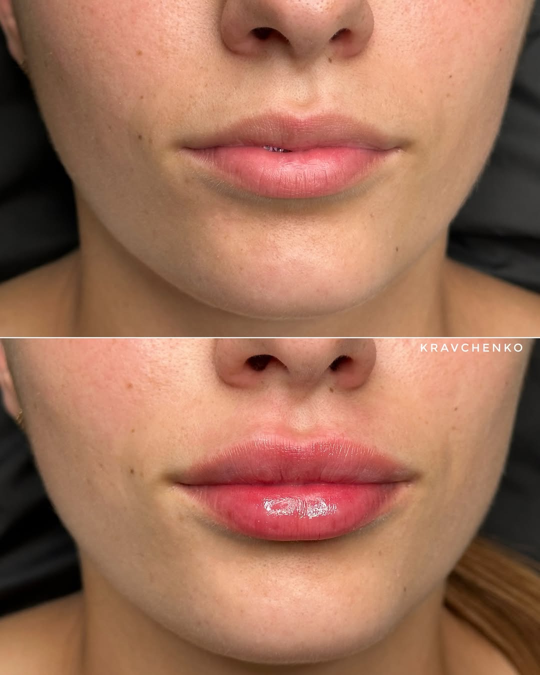Збільшення губ гіалуроновою кислотою, фото - Лікар-косметолог Філіпп Кравченко