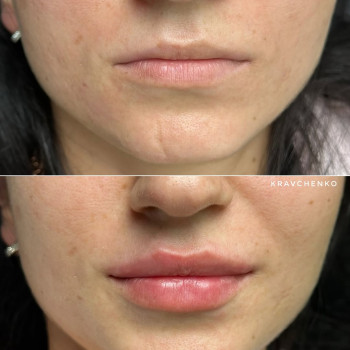 Збільшення губ гіалуроновою кислотою
