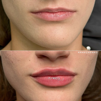 Збільшення губ гіалуроновою кислотою