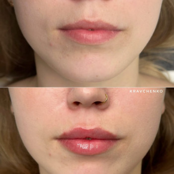 Збільшення губ гіалуроновою кислотою
