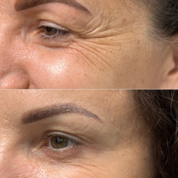 Ботокс навколо очей | Ботокс вокруг глаз