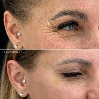 Ботокс навколо очей | Ботокс вокруг глаз