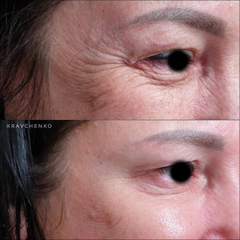 Ботокс навколо очей | Ботокс вокруг глаз