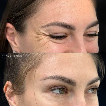 Ботокс навколо очей | Ботокс вокруг глаз