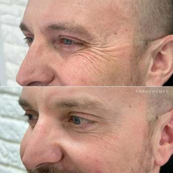 Ботокс навколо очей | Ботокс вокруг глаз