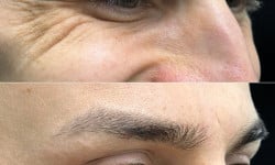 Ботокс вокруг глаз Лікар-косметолог Филипп Київ