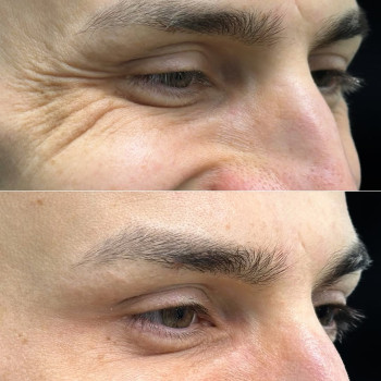 Ботокс навколо очей | Ботокс вокруг глаз