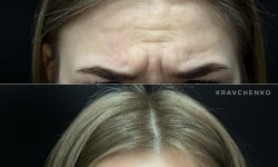 Ботокс межбровья Лікар-косметолог Филипп Київ