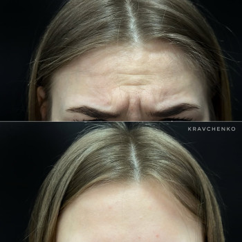Ботокс в міжбрівʼя | Ботокс в межбровье