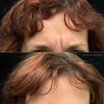 Ботокс в міжбрівʼя | Ботокс в межбровье