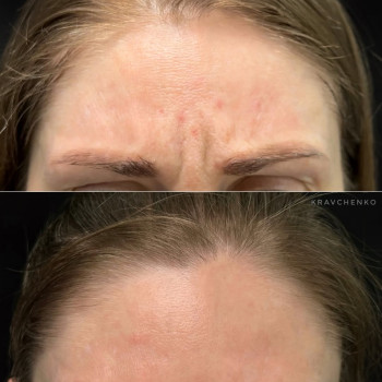 Ботокс в міжбрівʼя | Ботокс в межбровье