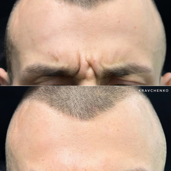 Ботокс в міжбрівʼя | Ботокс в межбровье