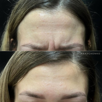 Ботокс в міжбрівʼя | Ботокс в межбровье