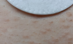 Электроэпиляция Электролог (мастер электроэпиляции) Катя Харьков