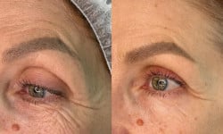 Ін’єкції полімолочної кислоти Belar PLLA Косметолог Анастасия Дніпро