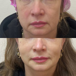 Біоревіталізація Дерматолог косметолог Нелли Киев