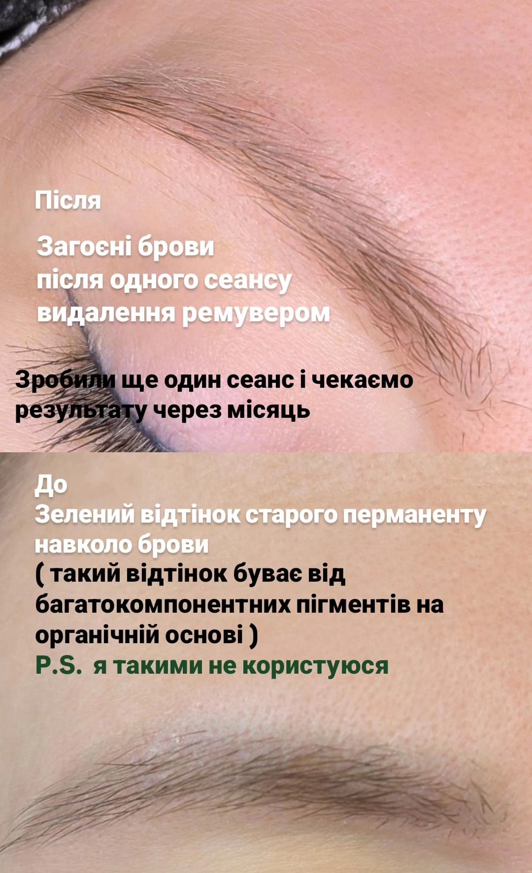 Видалення татуажу лазерне ремувером, фото - Бровіст Світлана К