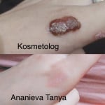 Удаление бородавок, папиллом, кератом жидким азотом со скидкой 33 % Мастер по пирсингу Татьяна Киев