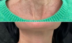 Ботулинотерапия Врач-косметолог Филипп Киев