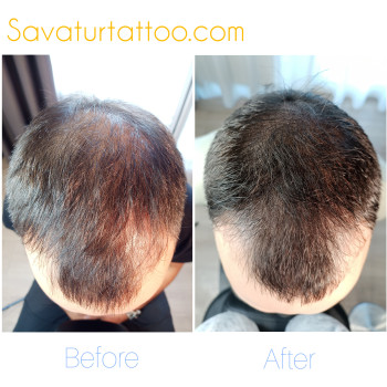 SMP Трихопигментация Україна Київ, маскування порiдiлого волосся, шрамiв, лисини, алопецii