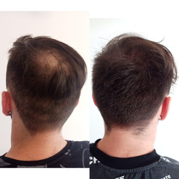 Трихопігментація SMP мікропігментація голови Київ, татуаж лисини, імітація волос, волосяні фолікулі, міноксіділ Україна, альтернатива трансплантації волосся, лікування волосся, випадіння волосся, порідіння волосся