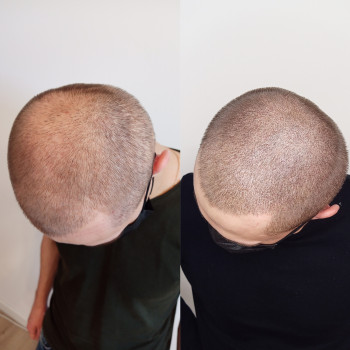 Медичний татуаж голови, лікування поріділого волосся, алопеціі, лисини, альтернатива трансплантации волосся, альтернатива меноксіділу, мікропігментація голови, маскування шрамiв на головi