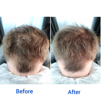 Медичний татуаж голови, лікування поріділого волосся, алопеціі, лисини, альтернатива трансплантации волосся, альтернатива меноксіділу, мікропігментація голови, маскування шрамiв на головi