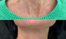 Ботокс платизмы шеи Лікар-косметолог Филипп Київ