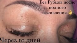 Ксантелазма Косметологический центр Laser Kosmo Запорожье