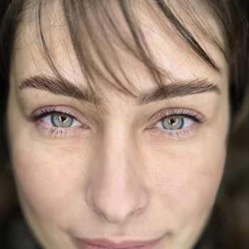 Загоєна міжвія і брови