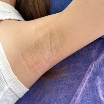 Лікування гіпергідрозу ботулінотерапією: 5500 грн