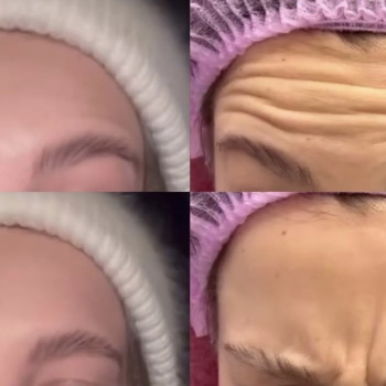 Ботулінотерапія верхньої частини обличчя